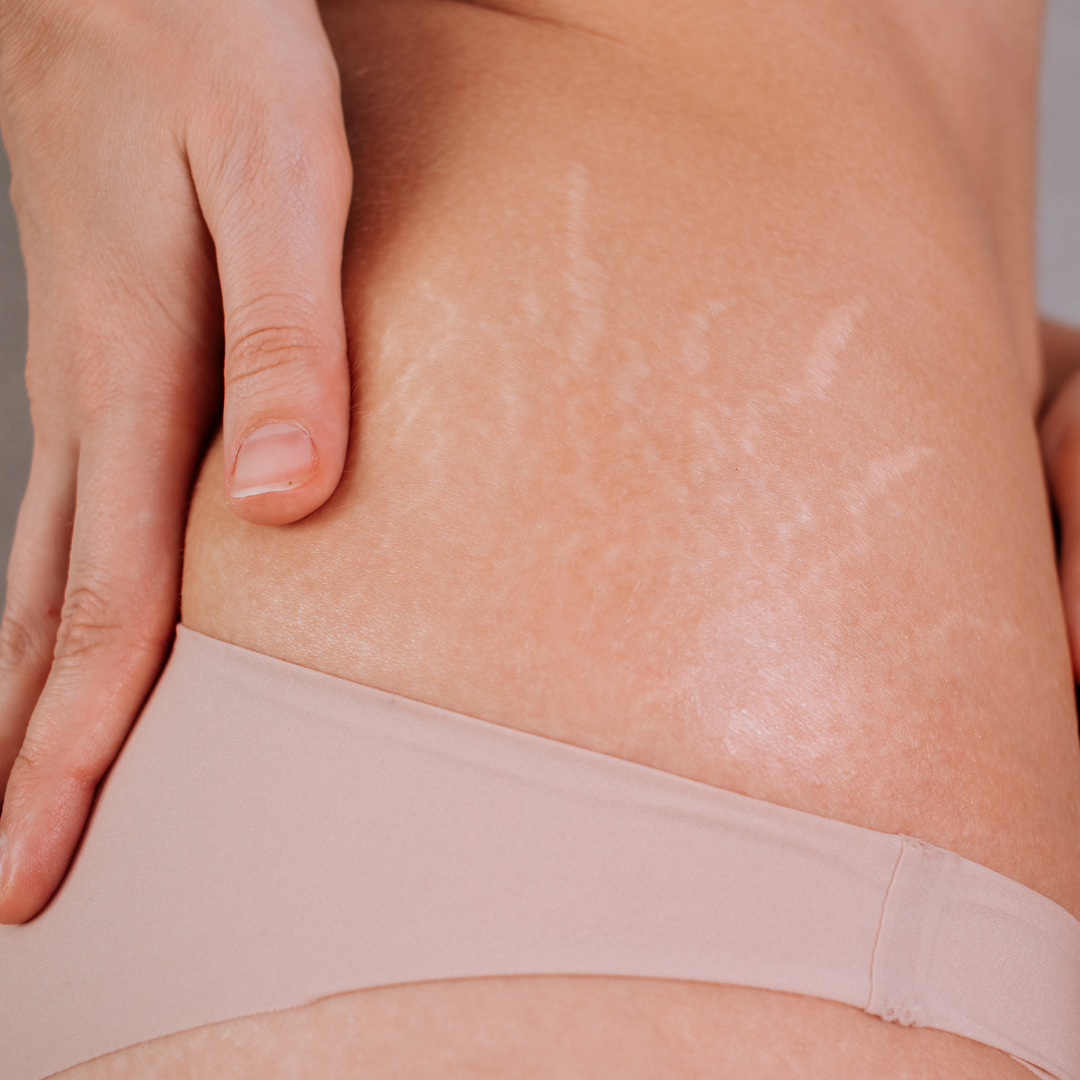 Stretch Marks Removal